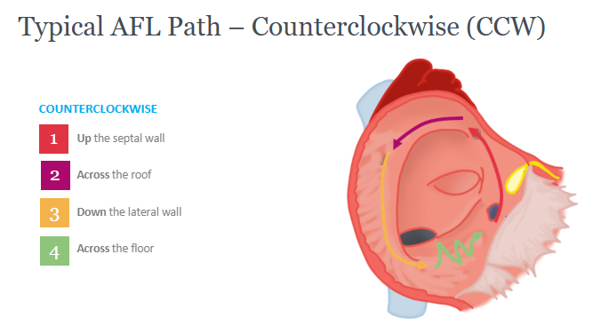 <ol><li><p>Along interatrial septum → utilize crista terminalis to move across roof → down lateral wall of CT → along RA floor (CTI) between anterior and posterior boundaries. </p></li><li><p>Passively via Bachmann’s bundle, through fossa ovalis, and/or through septum by means of CS/LA connection</p></li></ol><p></p>