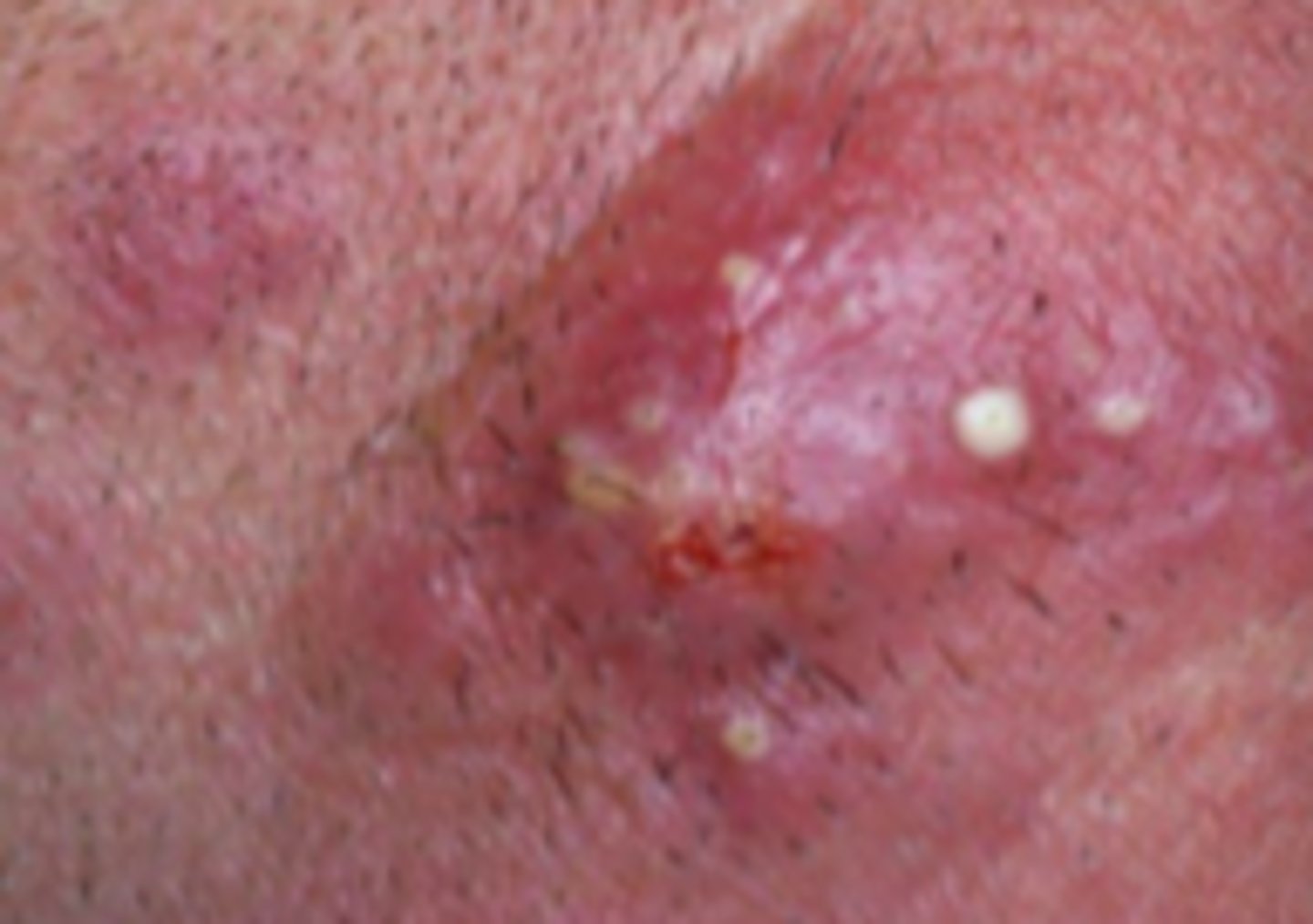 <p>Bacterial ID:</p><p>- Deep portions of hair follicles in bear areas of face and neck</p><p>- Due to S. aureus</p><p>Presents with tender pustules within erythematous plaques involving multiple hair follicles</p>