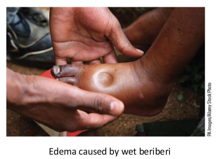 <p>Beriberi(2 types + 1 in baby)</p><ul><li><p>Dry - damage to nervous system; muscle weakness</p></li><li><p>Wet - damage to cardiovascular system; dilates blood vessels(edema-swollen extremities)</p></li><li><p>infantile - observed in infants</p></li></ul><p></p>