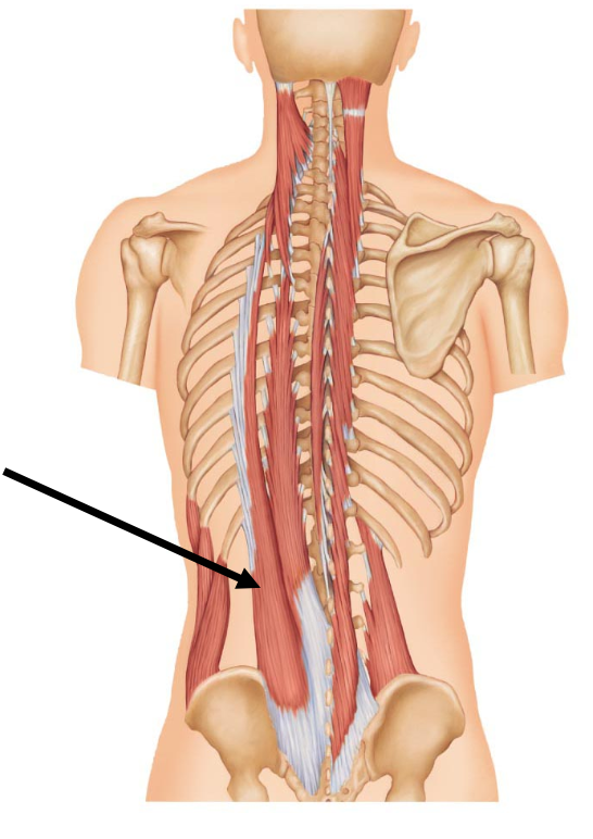 <p>The arrow is pointing to</p><p></p><p>A. iliocostalis</p><p>B. Spinalis</p><p>C. Semispinalis</p><p>D. Longissimus</p>