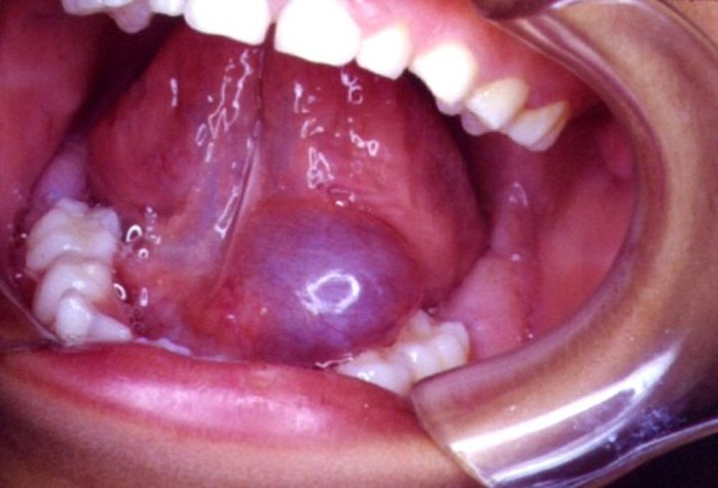 <p>"Mucocele of the floor of the mouth"</p><p>Usually associated with sublingual gland</p><p>Floor of mouth swelling</p>