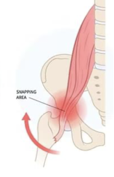 <p>What type of Coxa Saltans is caused by iliopsoas tendon snapping over the iliopectineal eminence, femoral head or anterior hip structures (repetitive hip flexion peeps)</p>