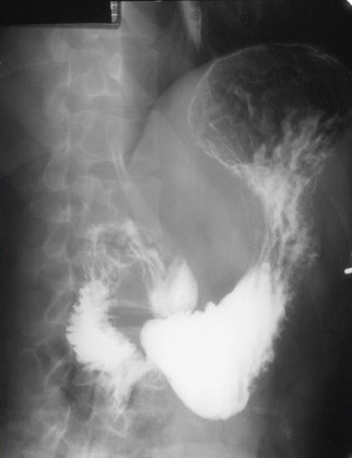 <p>What is this x-ray demonstrating?</p>