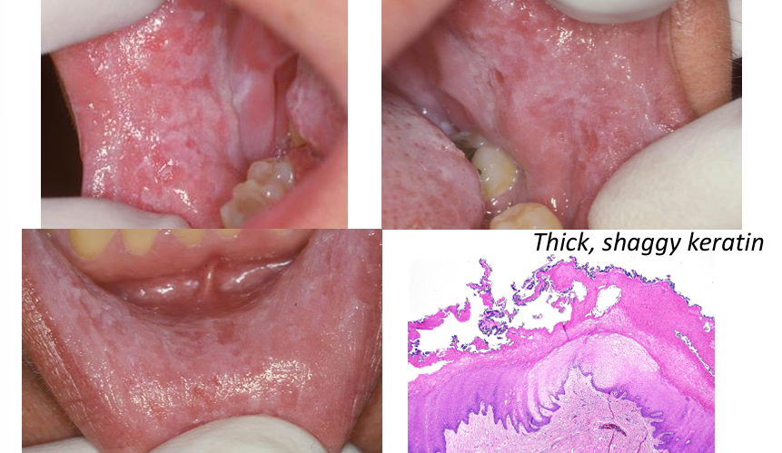 <p>-chronic, chewing/nibbling-induced hyperkeratosis</p><p>-white papules and plaques with a shaggy irregular surface</p><p>-focal erosions or erythema, sometimes ulcerated</p><p>-patients may describe being able to remove shreds of white material</p><p>-generally poorly demarcated, diffuse borders</p>