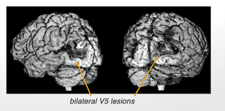<ul><li><p>loss of vision for movement</p><ul><li><p>unable to intercept moving objects </p></li></ul></li><li><p>due to lesion in V5</p></li></ul><p></p>