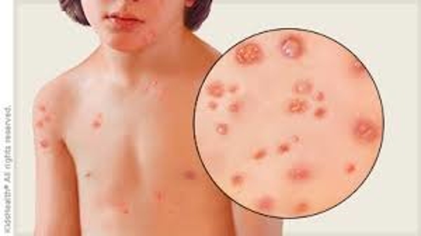 <p>Elevated cavity containing free fluid, up to 1 cm; a "blister." Clear serum flows if wall is ruptured. Examples: herpes simplex, early chickenpox, herpes zoster</p>
