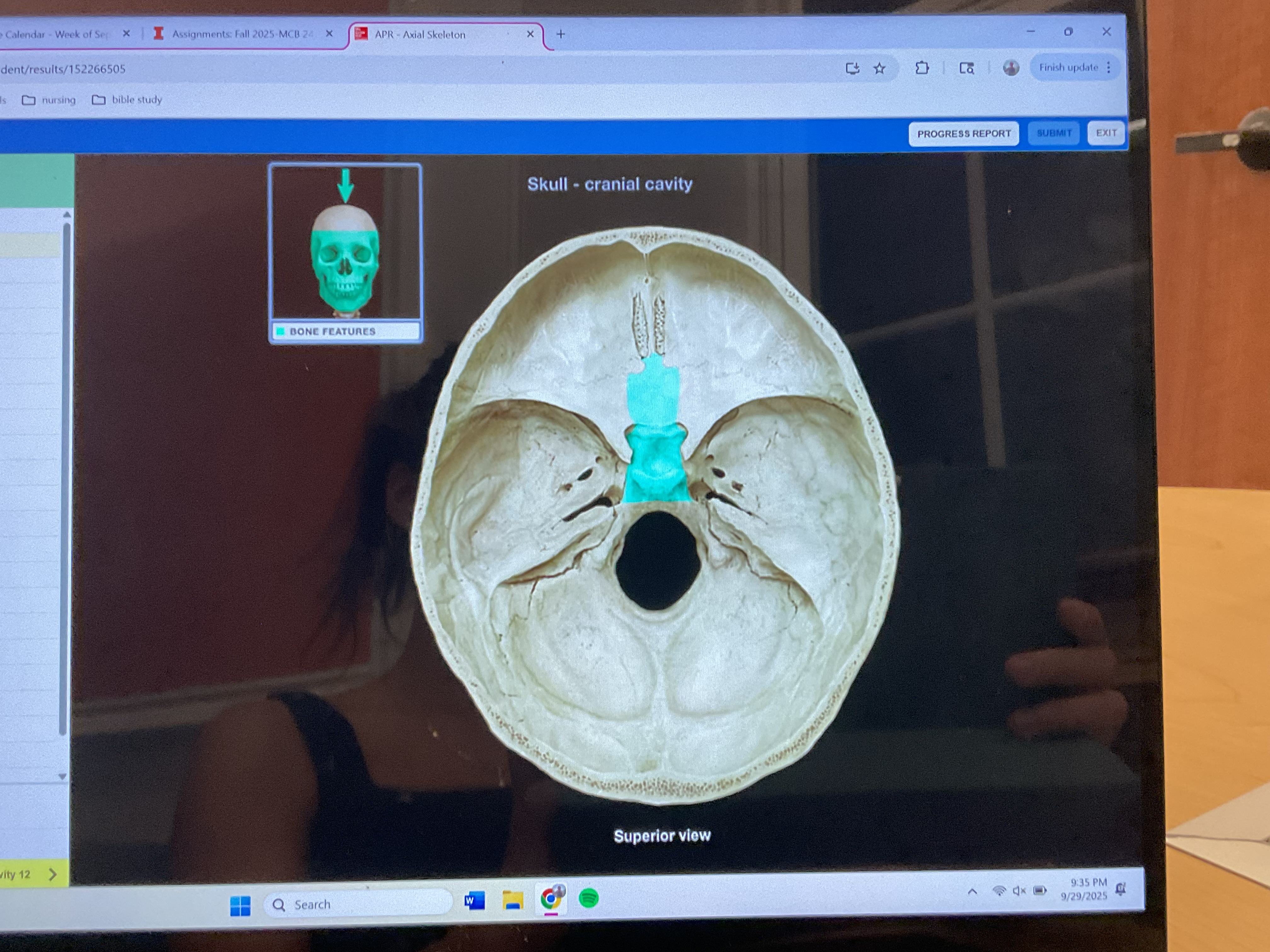 <p>Body of sphenoid bone </p>
