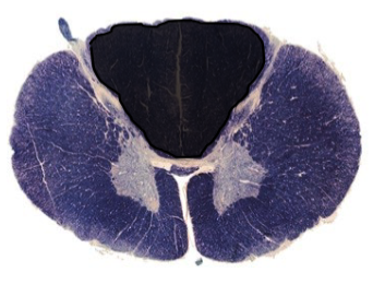 <p>a lesion here would cause…?</p>