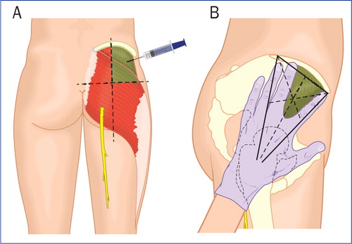 <p>B) Superolateral</p>