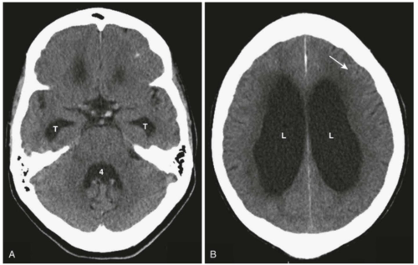 <p>Define Condition:</p><p>-Hx: Adult onset (45-75 y/o), +/- Hx of meningitis/SDH/TBI affecting CSF reabsorption</p><p>-Sx: Urinary incontinence, Gait Ataxia (falls), cognitive decline (dementia)</p><p>-PE: Frontal Lobe ataxia (magnetic gait - "stuck to the floor"), LE hypertonia, NO PAPILLEDEMA (*think "wet, wacky, wobbly"*)</p><p>-Dx: CT WOC (ENLARGED LATERAL VENTRICLES but NO ATROPHY)/Brain MRI (communicating hydrocephalus WITHOUT atrophy - VENTRICULAR ENLARGEMENT) + LP (normal, or 5-20 cm H2O)</p><p>-Tx: VPS/ventriculo-peritoneal shunt within 2 yrs of onset</p>