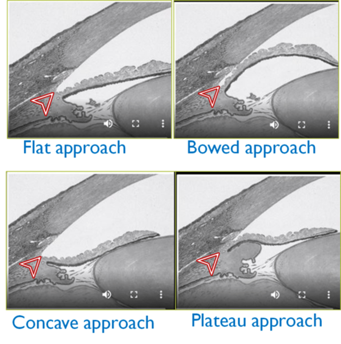 <p>iris is pushed forward → pupil margin may have too much contact with lens</p>