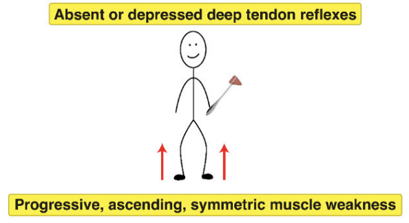 <ul><li><p>RF: <strong>Campylobacter jejuni —&gt; Follows resp/GI illness</strong></p></li><li><p>S/S: Destruction of myelin in schwann cells —&gt; <strong>Progressive symmetric ascending flaccid paralysis &amp; weakness,</strong> ambulatory dysfunction, paresthesias, resp compromise, <strong>DTE decreased/absent</strong></p></li><li><p>Dx: <strong>LP &amp; CSF analysis —&gt; Elevated CSF protein,</strong> EMG/nerve conduction studies</p></li><li><p>Tx: Vent support, plsamapharesis/IVIG</p></li></ul><p></p>