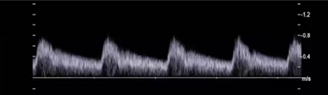<p>Considering waveform, is this artery feeding a high or low resistant vascular bed?</p><p>why?</p><p>which type of anatomical structure would require an artery providing this type of flow?</p>