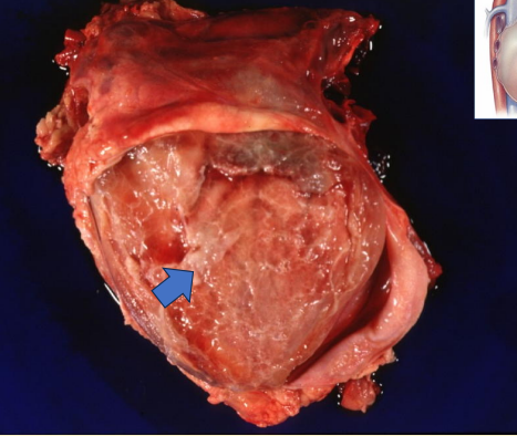 <p>What happens to the pig’s heart when it has strep suis?</p>