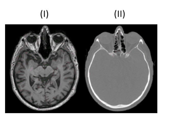 <ul><li><p>Weniger Kontrast bei Weichgewebe</p></li><li><p>Weiße Knochen</p></li></ul><p></p>