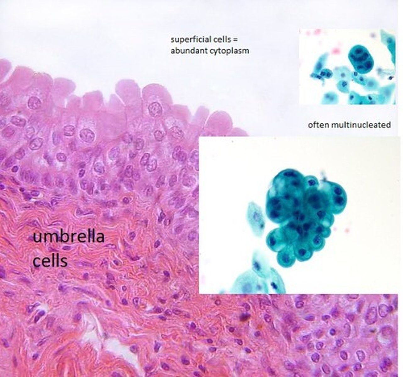<p>A term for a multinucleated superficial cell of the bladder's transitional</p>