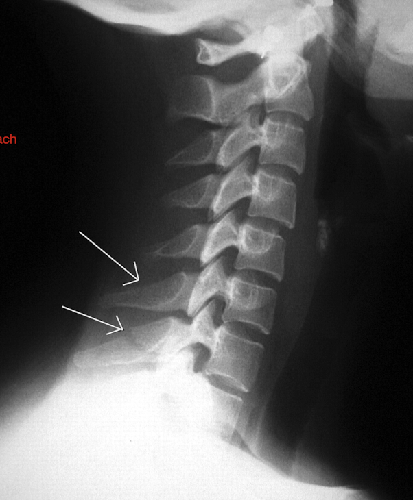 <ul><li><p>Type:</p><ul><li><p>Avulsion fx of the Spinous Process (where Rhomboid or Traps attach)</p></li></ul></li><li><p>MOI:</p><ul><li><p>Hyperflexion Force</p></li><li><p>Forceful contractions of the Trapezius or Rhomboids</p><p> </p></li></ul></li></ul><p></p>