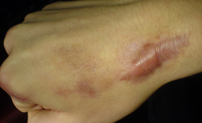 <p>เกิดจากการสร้าง collagen มากเกินไป และเปลี่ยน collagen type I → II</p>