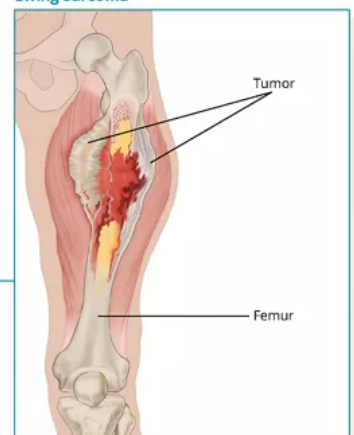 <p>What childhood cancer is this? </p>