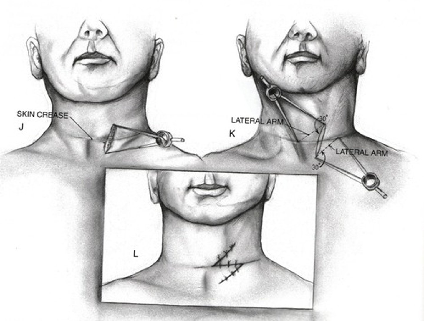 <p>surgical repair</p>