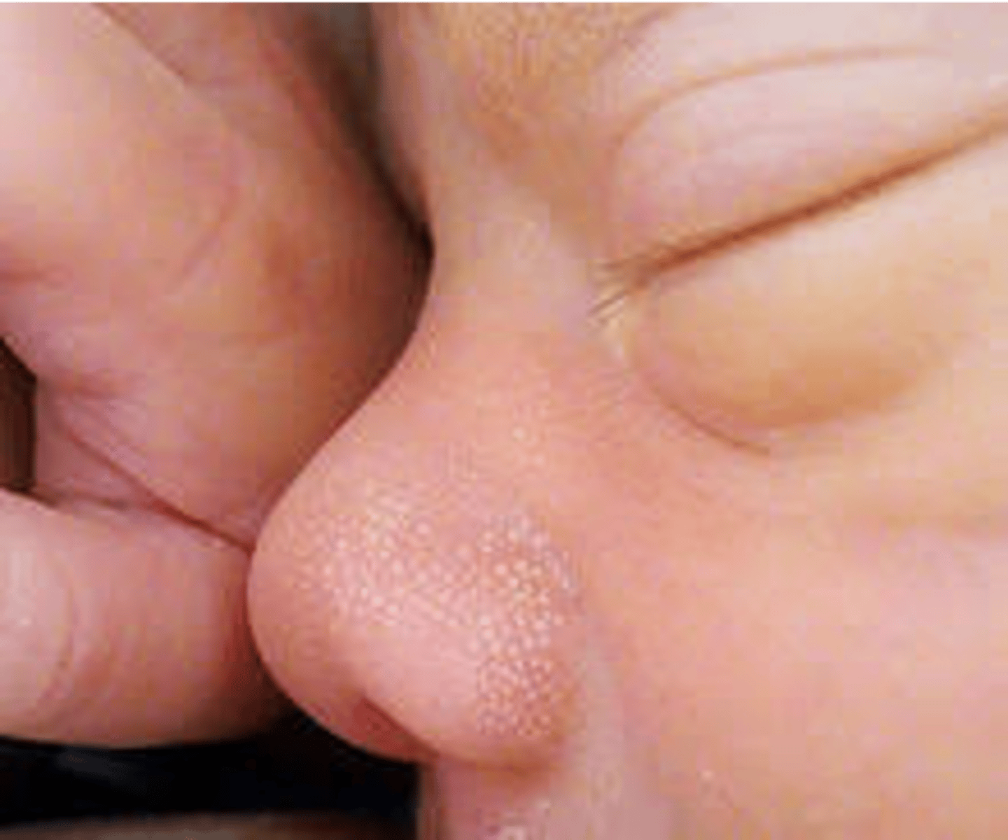 <p>pinhead sized smooth white raised areas without surrounding erythema on nose,chin, foreheat</p><p>usually appear within first few weeks and dissapear over several weeks</p>