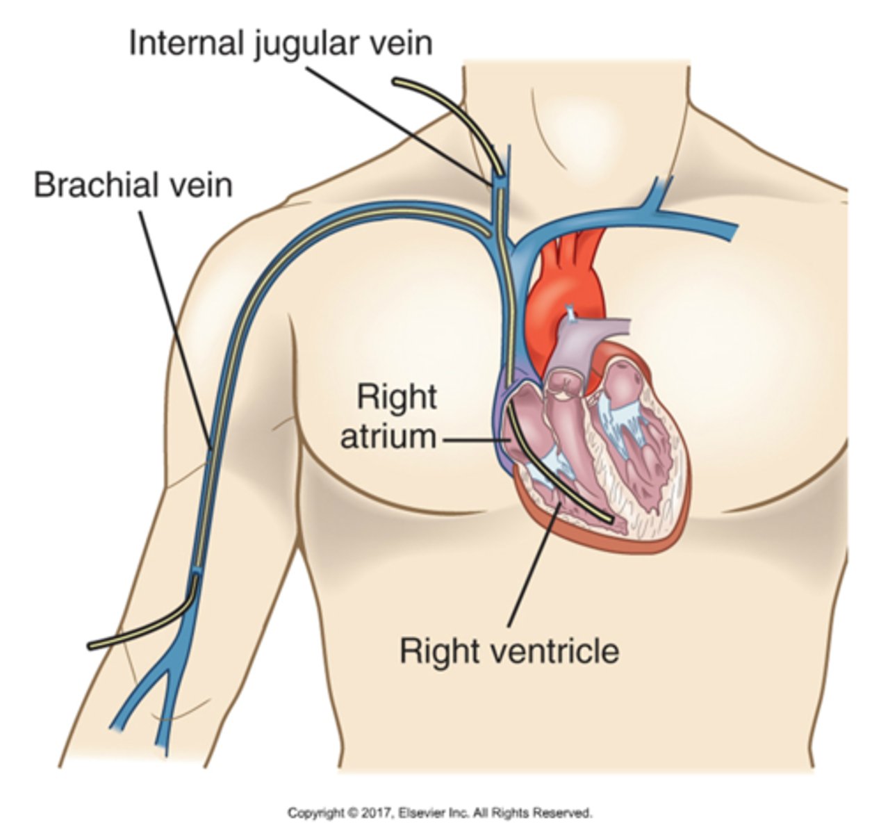 <p>1. Transcutaneous pacing (thru skin)</p><p>2. Transvenous pacing (catheter in heart)</p><p>3. Permanent pacer (implant)</p>