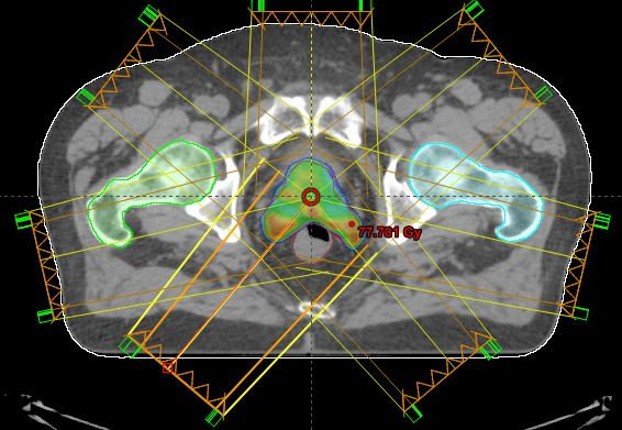 <p>We do not use parallel opposed beams </p>