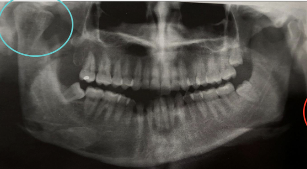 <p><span style="color: #0c0505">Excessive growth of condyle due to neoplasm, endocrine disturbances</span></p>