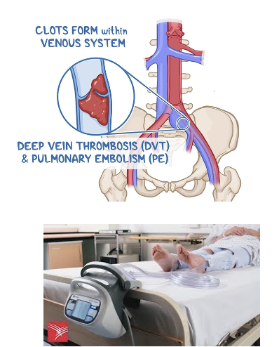 <ul><li><p>Blood clot that develops in the venous vasculature that could develop into a <strong>DVT or PE</strong></p></li><li><p>Greater risk d/t immobility, flaccidity, ↓ vasomotor tone</p></li><li><p><strong>Presents as</strong> <em>pleuritic chest pain, anxiety, shortness of breath, ↑PaCO2 (hypercapnia), ↓PaO2 (hypoxia)</em></p><ul><li><p>Unilateral swelling, low-grade fever, temp change in affected limb</p></li></ul></li><li><p><strong>Prevention</strong>:<span style="color: yellow"> <em>low-dose anticoagulation therapy</em></span></p><ul><li><p>Use of sequential pneumatic compressions (SCDs)</p></li><li><p>Permanent indwelling filters</p></li><li><p>Range-of-motion exercises</p><p></p></li></ul></li></ul><p></p>