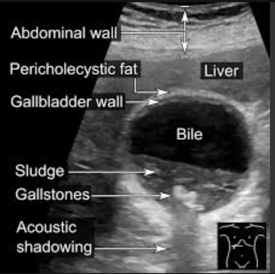 <p>Bile stasis; precursor to stone formation; can mimic mass</p><p></p><p>Low-level echoes layering dependently; no shadowing mobile with position change</p><img src="blob:null/1fe03dcb-7efe-4939-9b57-1c5cbcc9839d">
