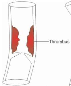 <p>Thrombus</p>