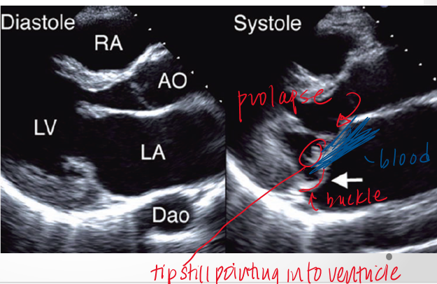 <p>upward and back into left atrium but tips still point into LV </p>