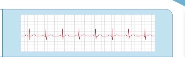 <p>normal beat - evenly spaced</p>