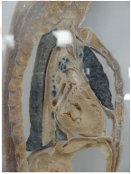 <p>The mediastinum is the central compartment of the thoracic cavity, located between the lungs. It contains vital structures such as the heart, trachea, esophagus, and major blood vessels and includes the mediastinal pleura. </p>