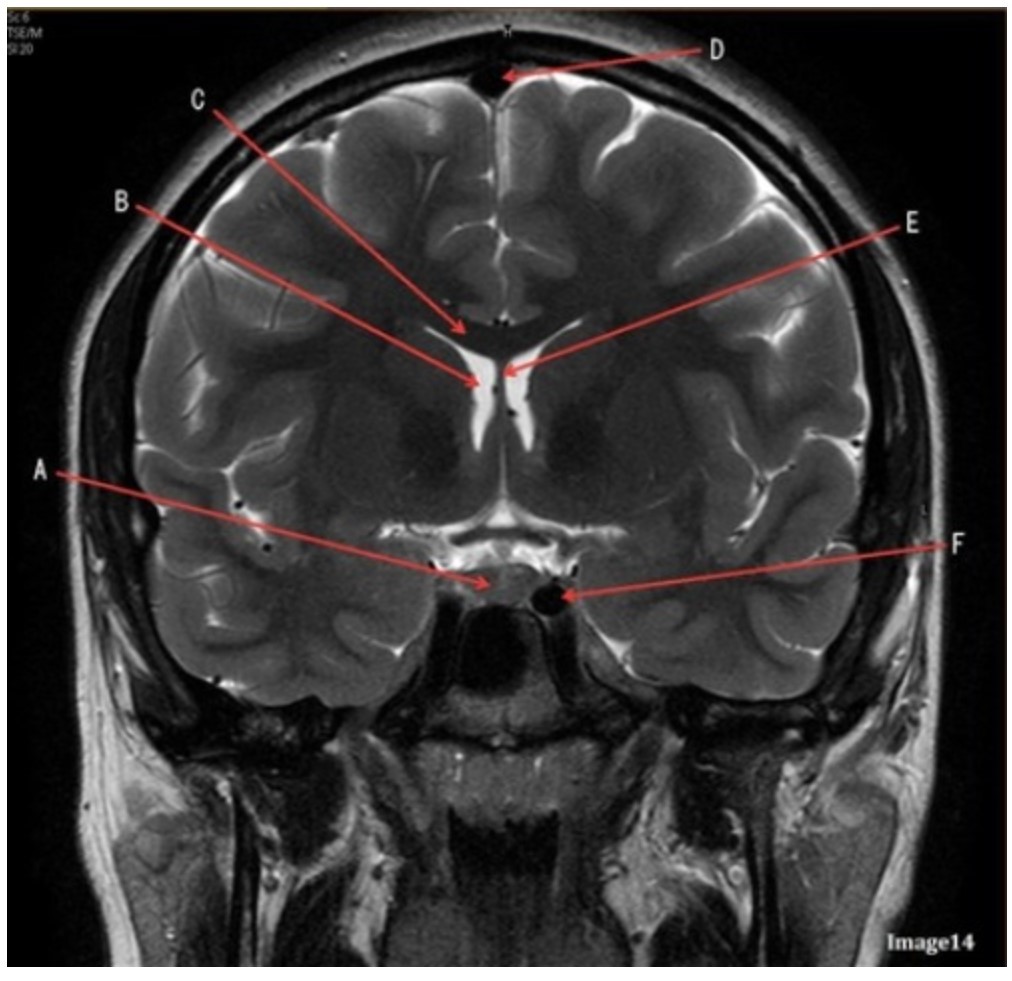 <p><span><strong>Letter C in Image 14 is pointing to:</strong></span></p><p><span>&nbsp;A. Corpus callosum</span></p><p><span>&nbsp;B. Third ventricle</span></p><p><span>&nbsp;C. Lateral ventricle</span></p><p><span>&nbsp;D. Pituitary gland</span></p><p><span>&nbsp;E. Fornix</span></p>
