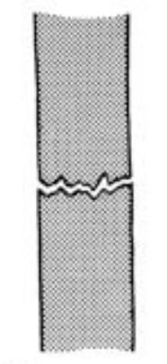 <p>What classification of fracture is this?</p>