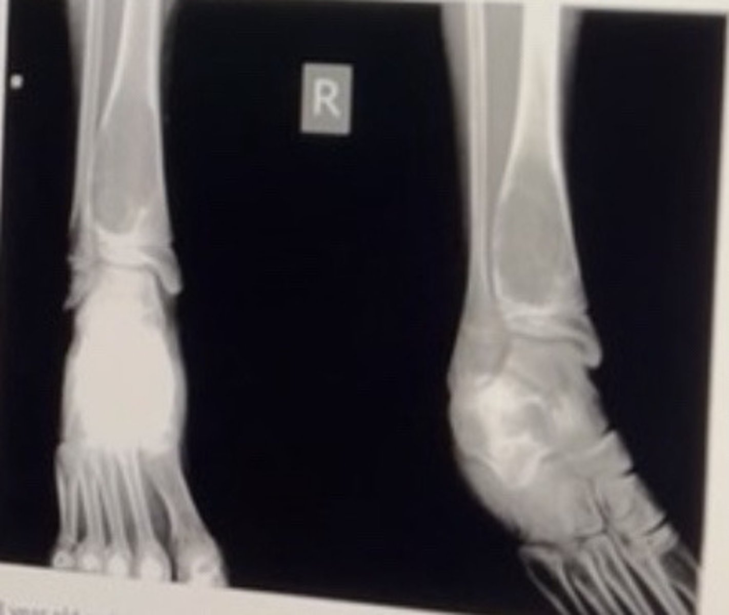 <p>13 year old male with right ankle pain and swelling of approximately 3 months duration.</p><p>Best diagnosis:</p><p>• Aneurysmal bone cyst</p><p>• Osteochondroma</p><p>• Plasmacytoma</p><p>• Ewing sarcoma</p>