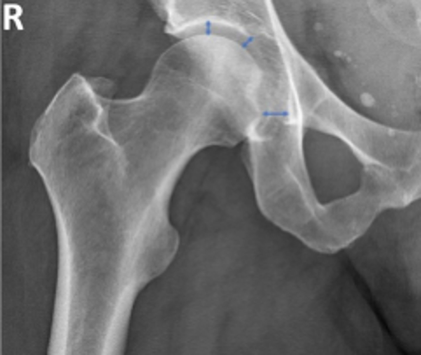 <p>Name 2 radiographic views for this assessment?</p>