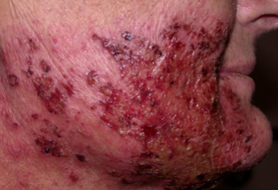 <p>occurs after radiation therapy </p>