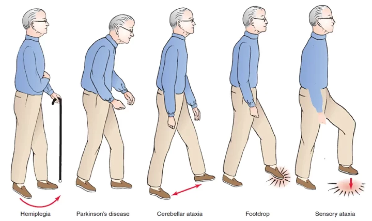 <ul><li><p>abnormal gait patterns</p><ul><li><p>ataxia</p></li><li><p>foot slapping</p></li><li><p>hemiplegic gait</p></li><li><p>Parkinsonian gait</p></li><li><p>scissors gait</p></li><li><p>spastic gait</p></li></ul></li><li><p>structural abnormalities</p></li><li><p>limb dysfunction</p></li><li><p>favoring one side</p></li><li><p>presence of tremors</p></li><li><p>paralysis</p></li><li><p>weakness</p></li><li><p>limb atrophy</p></li><li><p>redness, swelling of a joint</p></li><li><p><span>the use of assistive devices like canes, walkers, or wheelchairs</span></p></li></ul>