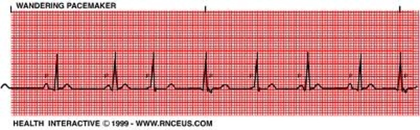 <p>Hint: try never to pick this</p><p>- impulse originate from varying points in atria</p><p>- variation in P wave contour, PR-I, PP-I and thus RR-I</p>