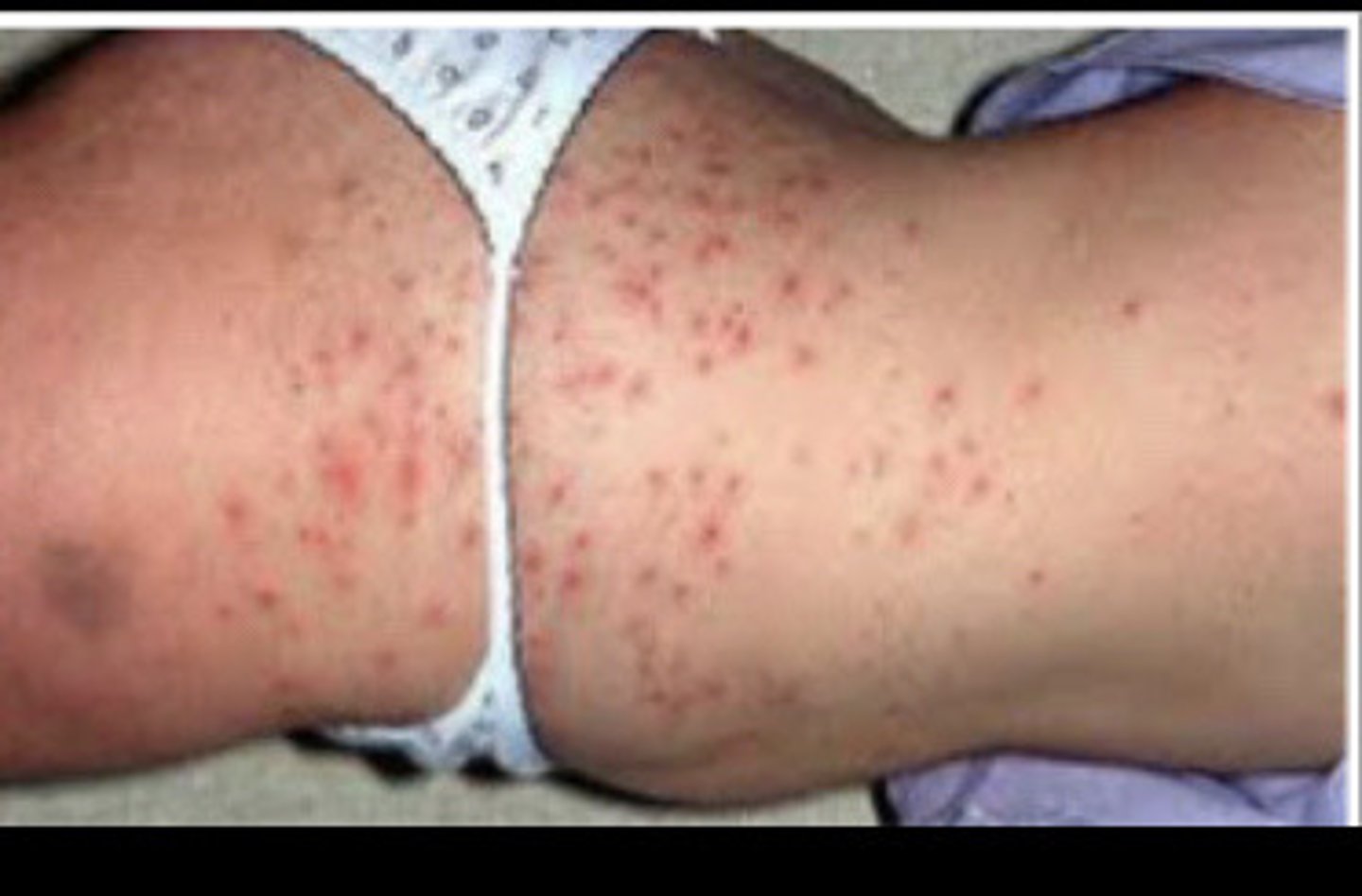 <p>1) BPO+ Topical Clindamycin<br>2) Oral antibiotics (Cipro)</p>