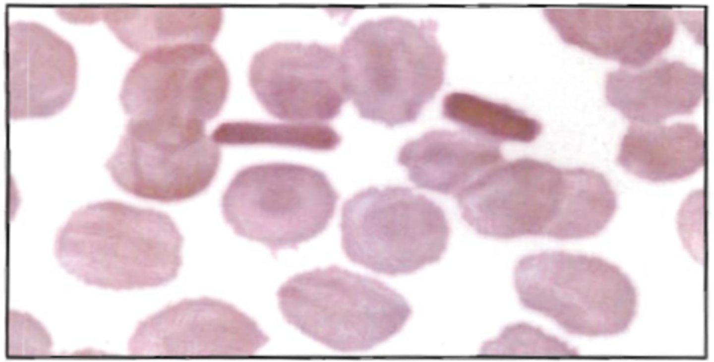 <p>75. The smear represented below displays:</p><p>A. congenital ovalocytosis</p><p>B. hemoglobin C disease</p><p>C. poor RBC fixation</p><p>D. delay in smear preparation</p>