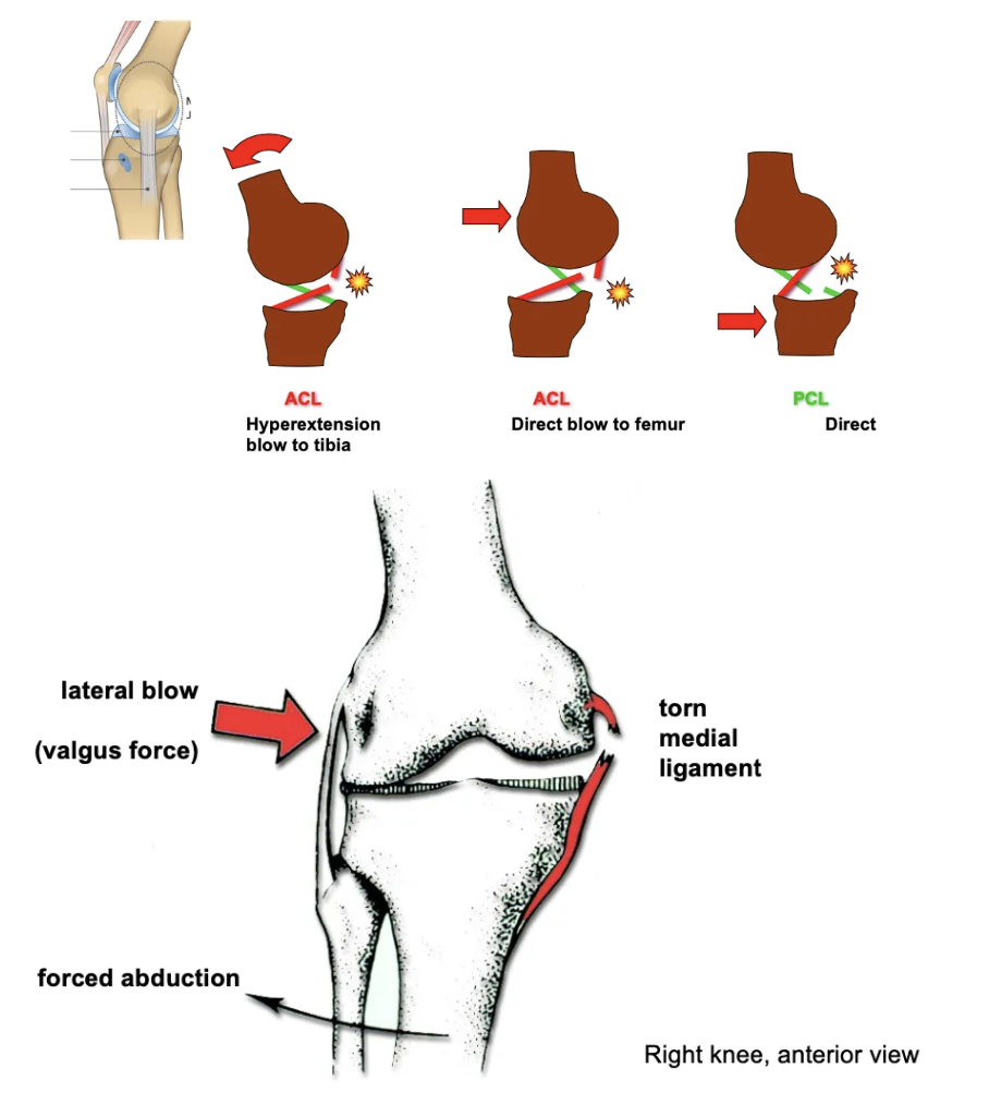 <ul><li><p>ACL: Hyperextension or direct blow to the femur.</p></li><li><p>PCL: Direct blow to the tibia.</p></li><li><p>Medial Ligament: Lateral (valgus) blow or forced abduction.</p></li></ul><p></p>