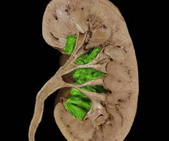 <p>Renal sinus</p>