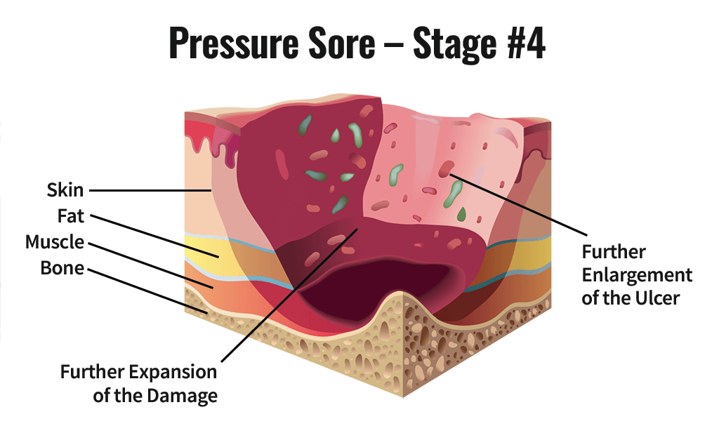 <p>Stage 4 Pressure Injury</p>