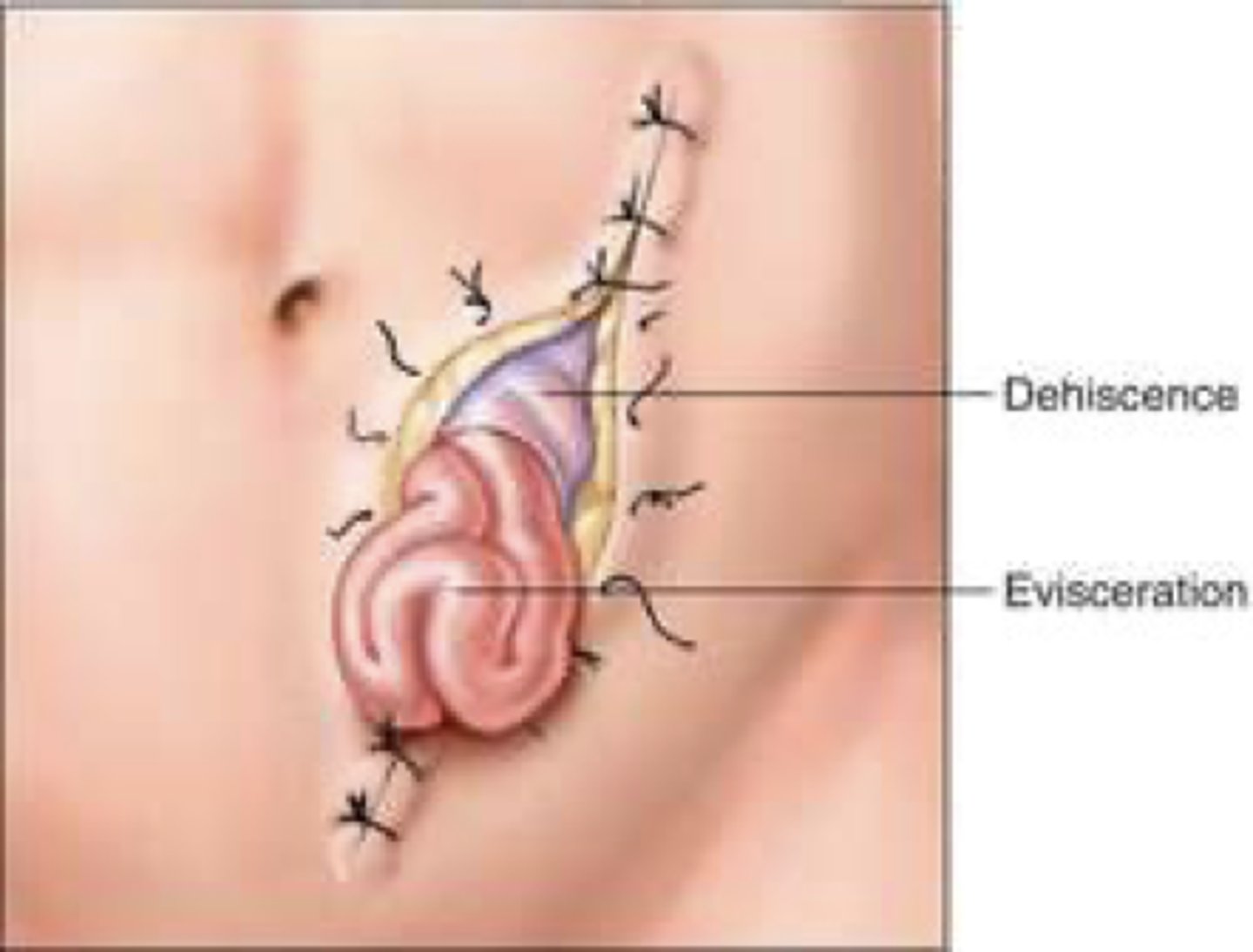 <p>d. increased serosanguineous drainage from the wound.</p><p>Increase in the serosanguineous drainage from the surgical wound is a common sign of impending dehiscence.</p>