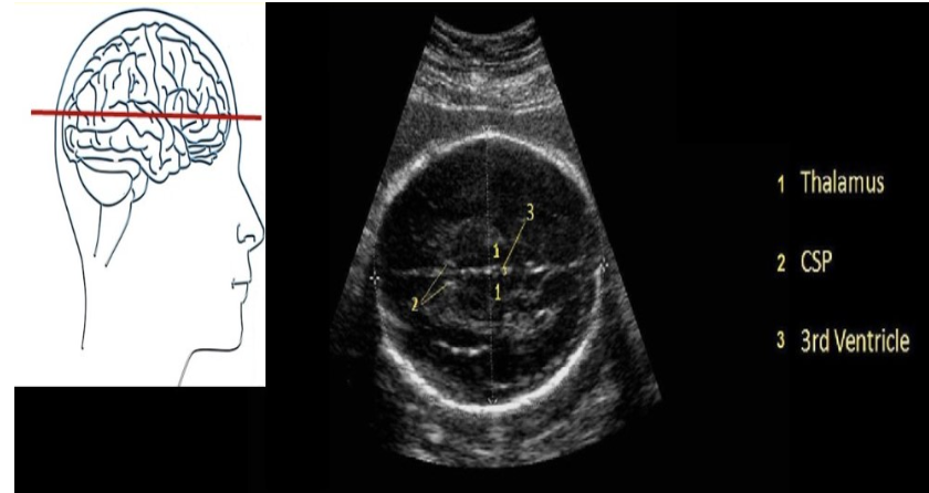 <p>d) 3rd ventricle</p>