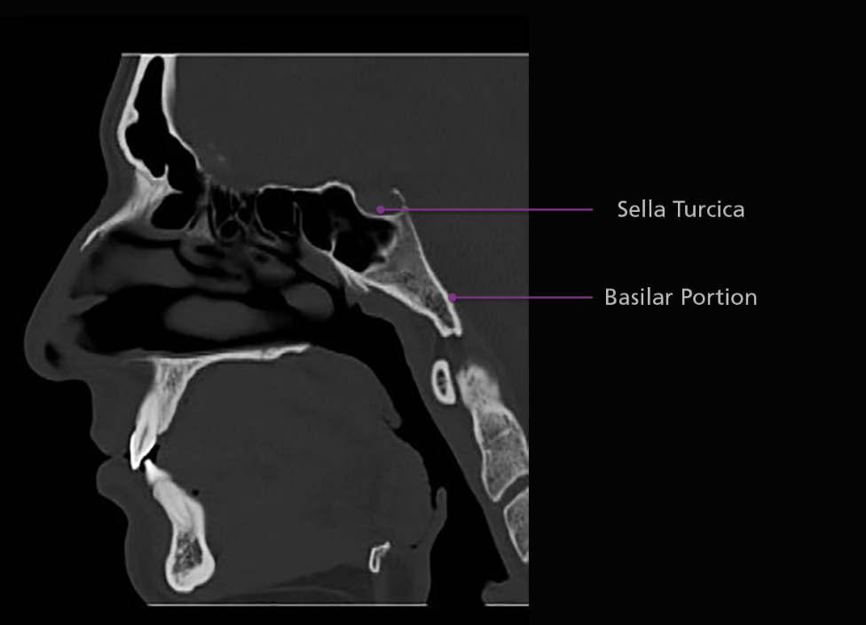 <p>The body of the sphenoid bone is cube-shaped and articulates posteriorly with the basilar portion of the occipital bone. The sphenoid sinuses are located within the body of the sphenoid bone, as is the sella turcica. The sella turcica, or “turkish saddle”, is a deep indentation in the superior surface of the posterior position of the body; it houses and protects the pituitary gland.</p>