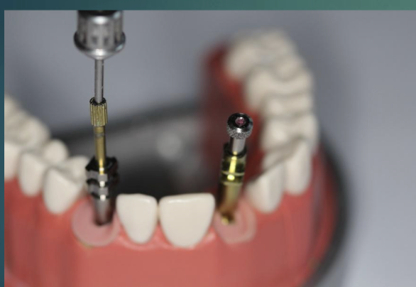 <ul><li><p>hand tighten guide pin to secure coping to the implant </p><ul><li><p>NEVER use hand wrench to tighten the guide pin </p></li></ul></li><li><p>make sure the impression coping is firmly connected w no mobility </p></li></ul><p></p>